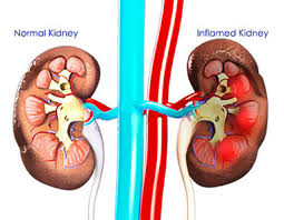 nephritis